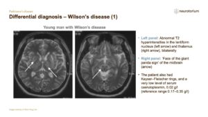 Differential diagnosis – Wilson’s disease (1)